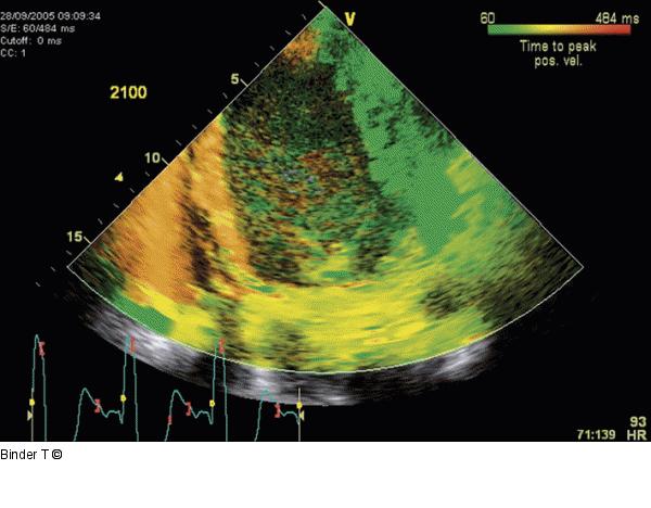 Tissue Synchronization Imaging (TSI)