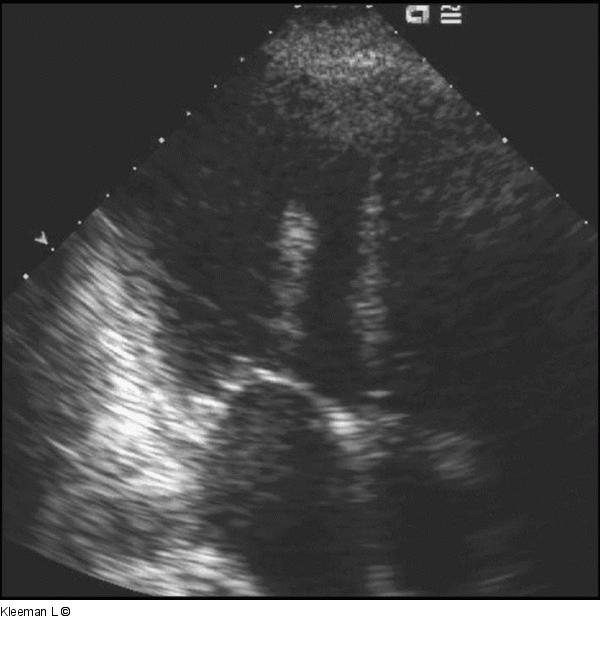 Transthorakales Echo