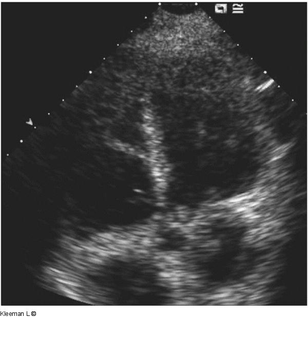 Transthorakales Echo