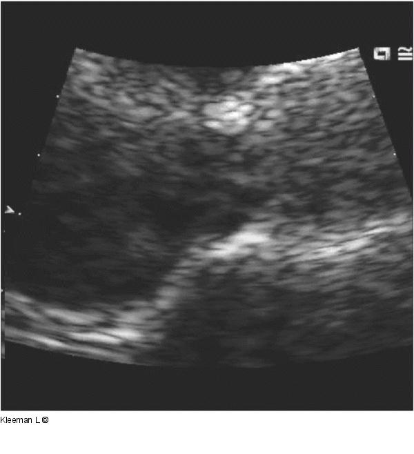 Transthorakales Echo