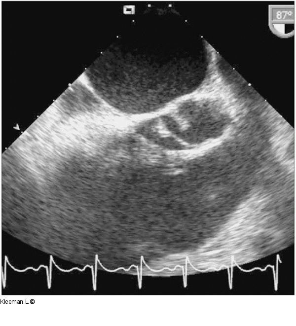 Transthorakales Echo