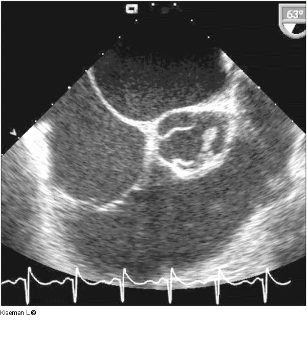 Transthorakales Echo