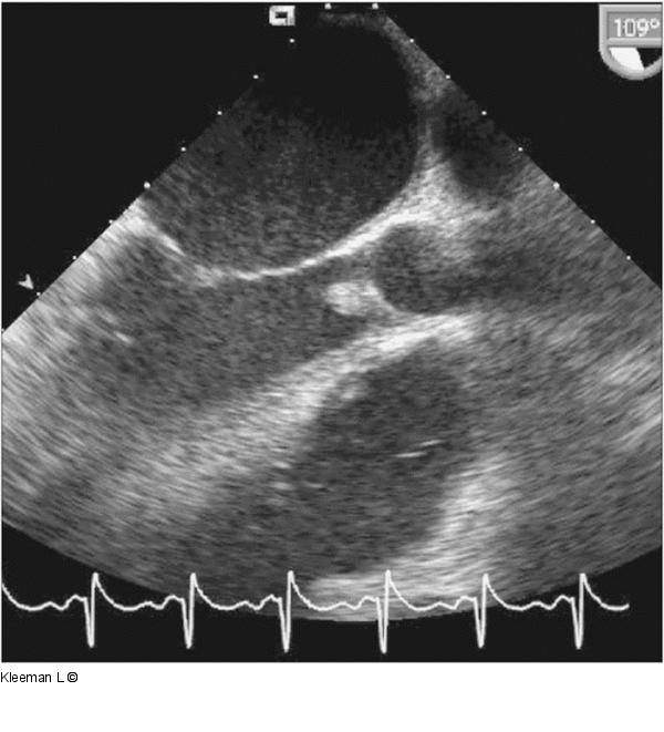 Transthorakales Echo