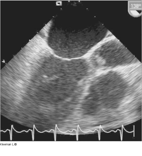 Transthorakales Echo