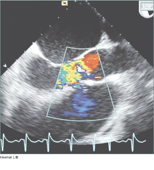 Transthorakales Echo