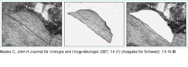 Laser Capture Microdissection Microscopy