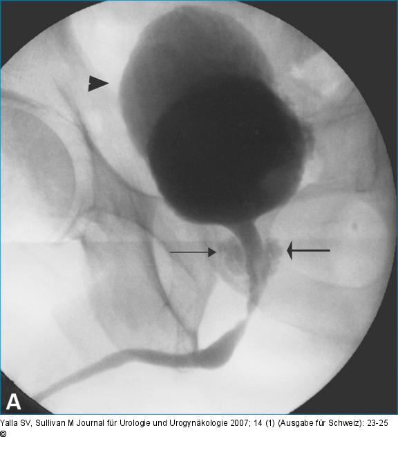 Cystourethrogram