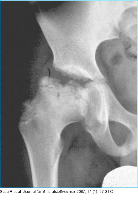 Head-at-Risk-Sign - Gage Sign