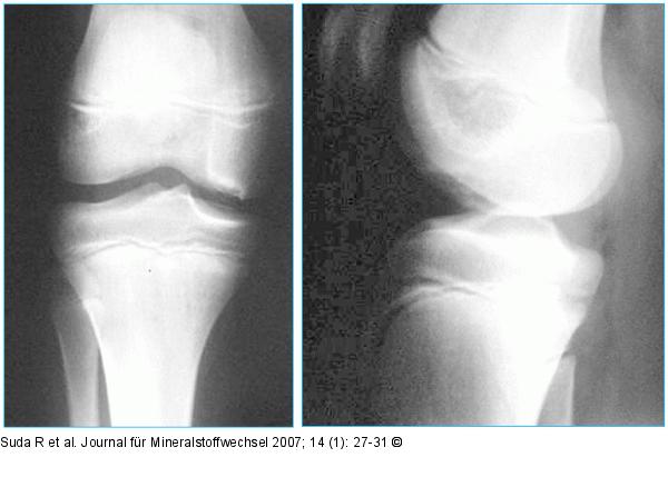 Osteochondrosis