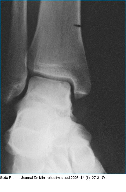 Osteochondrosis