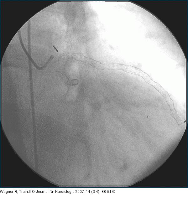 Stent-Leeraufnahme