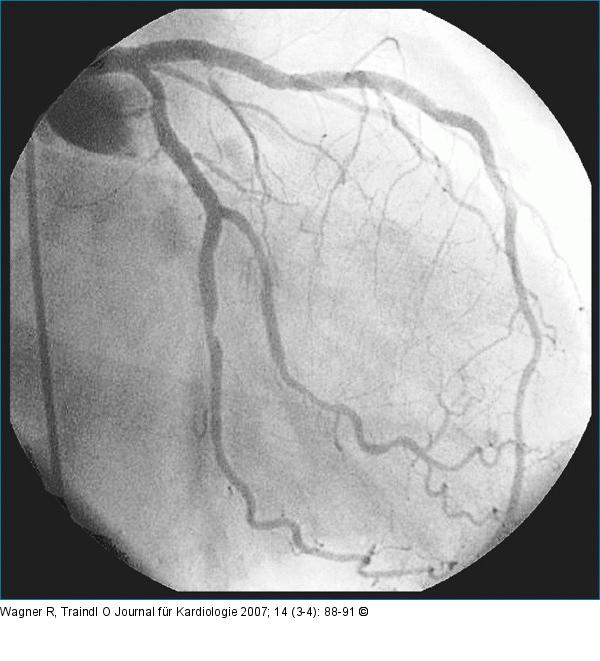 LAD-Stent