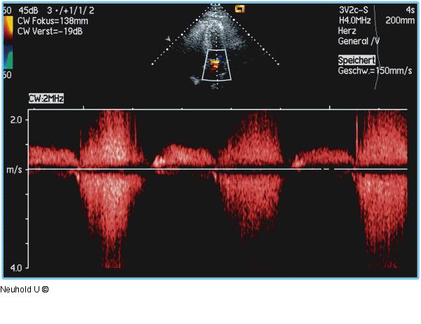 CW-Doppler