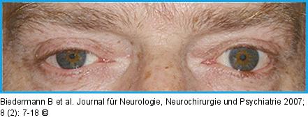 Horner-Syndrom