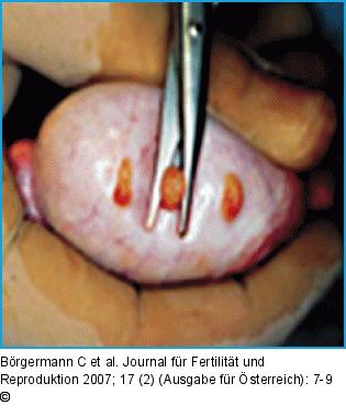 Operationssitus bei der Randombiopsie zur TESE