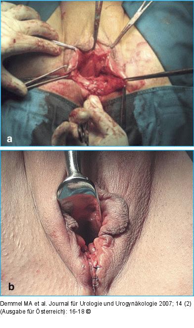 Intraoperativer Situs nach Rekonstruktion des M. sphincter ani externus