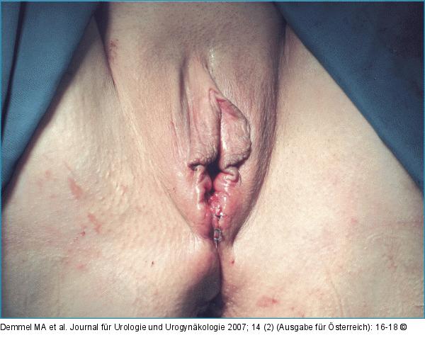 Intraoperativer Abschlubefund
