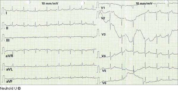 EKG