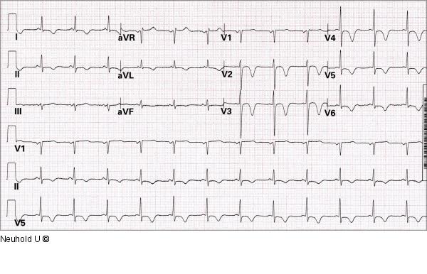 EKG