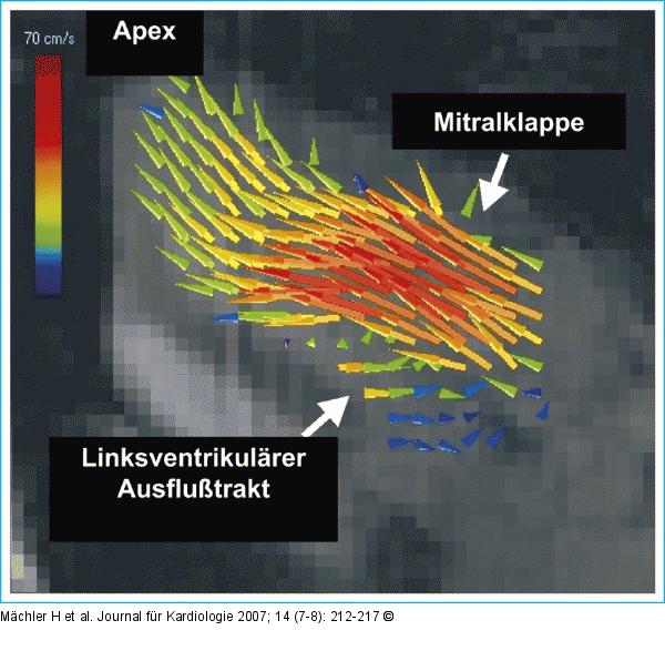 Linker Ventrikel
