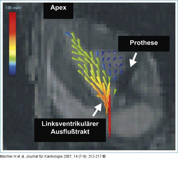 Endsystolischer Strmungscharakter