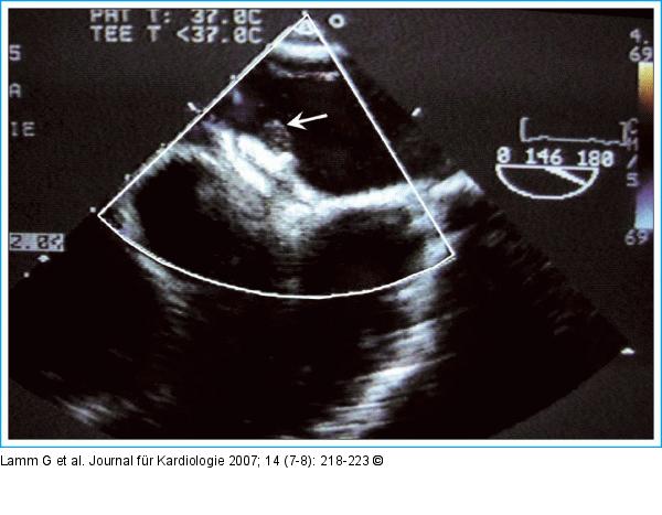 Thrombus