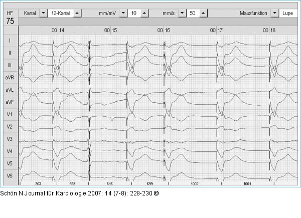EKG