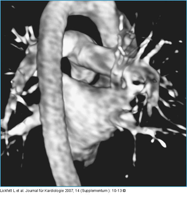 Spitzenpulmonalvene - Magnetresonanzangiographie