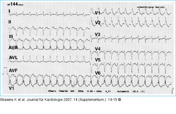 EKG