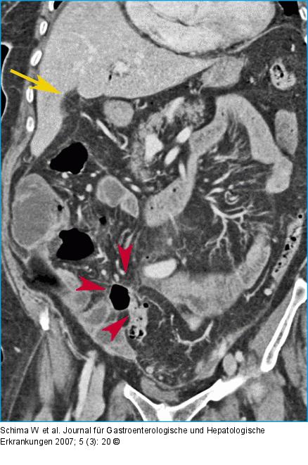 MDCT - 3D-Rekonstruktion