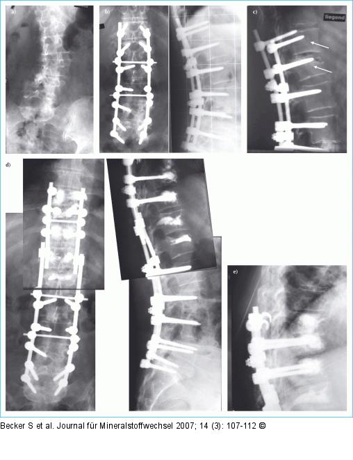Osteoporose