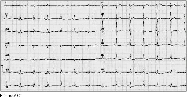 EKG