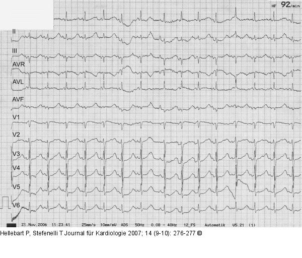 EKG