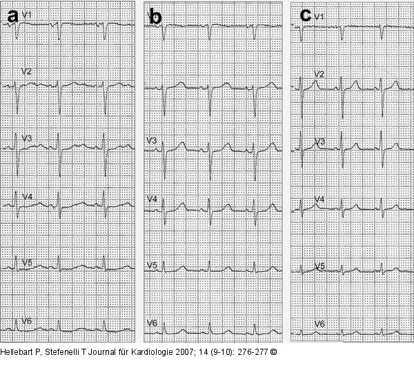 EKG