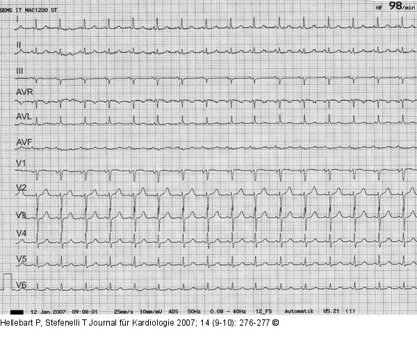 EKG