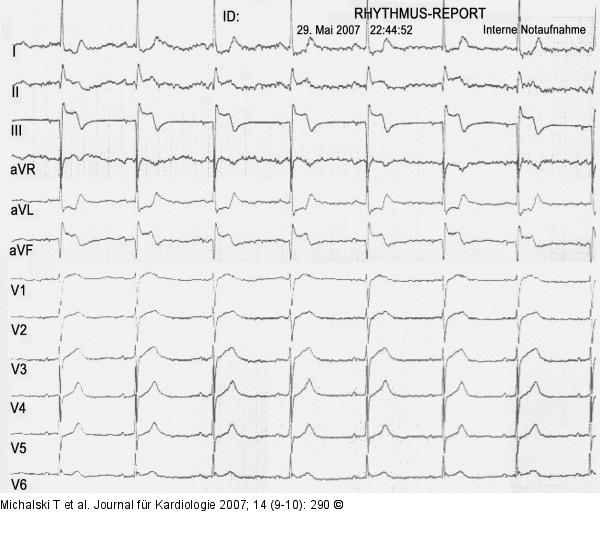 EKG