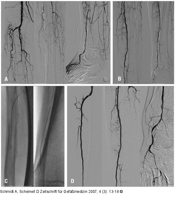 Diabetes mellitus - Ischmie
