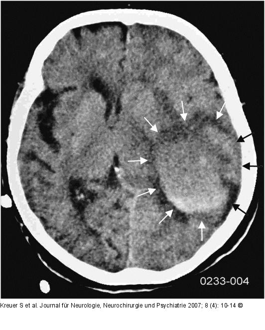 Diffuse Blutung