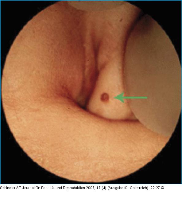 Endometriose