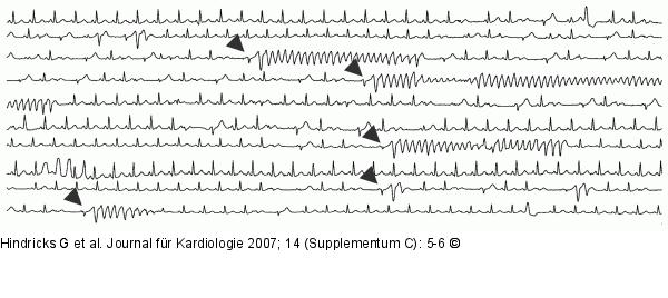 EKG