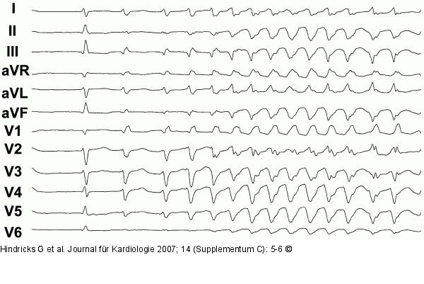 EKG