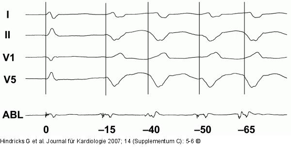 EKG