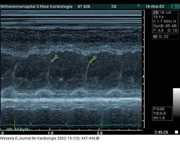 Pericarditis constrictiva
