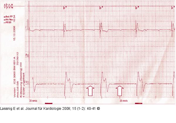 EKG