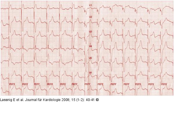 EKG