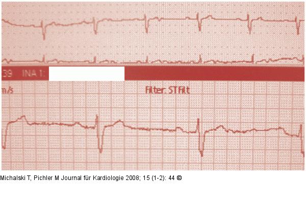 EKG