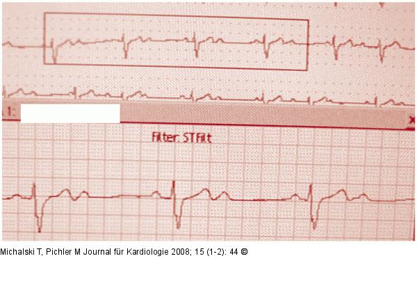 EKG
