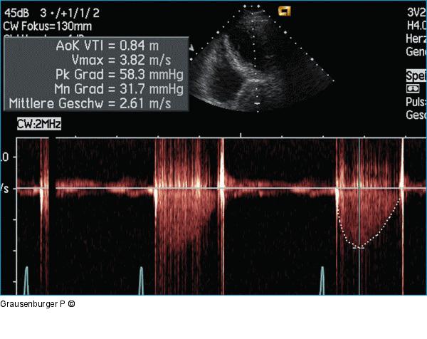 Aortenklappenprothese