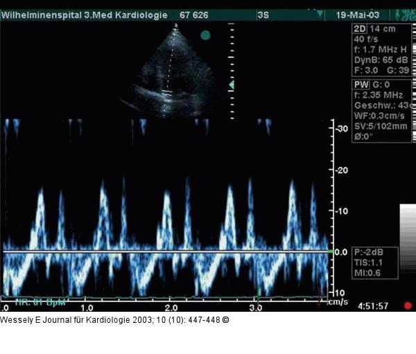 Pericarditis constrictiva
