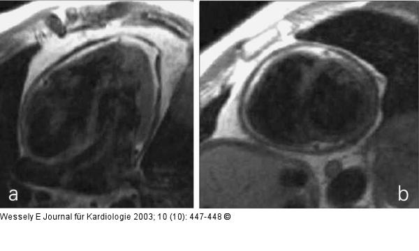 Pericarditis constrictiva